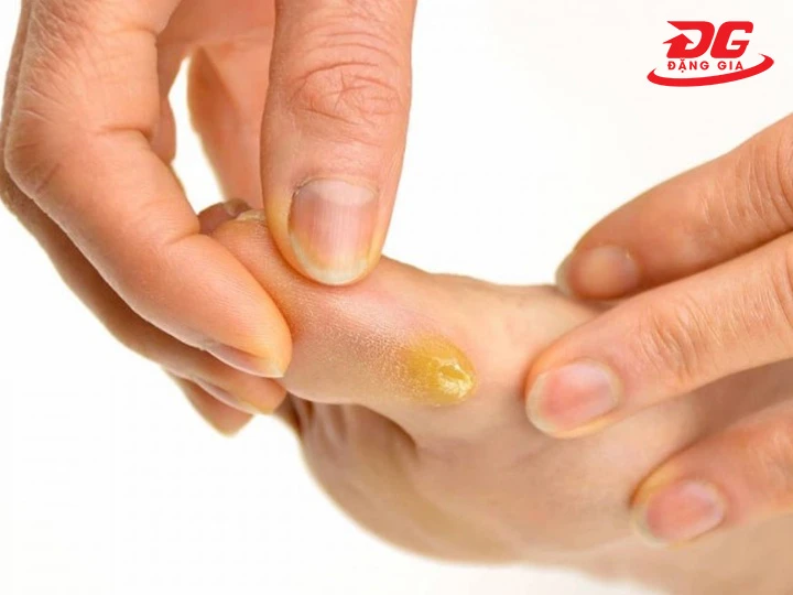 Hạn chế chai sần, phồng rộp