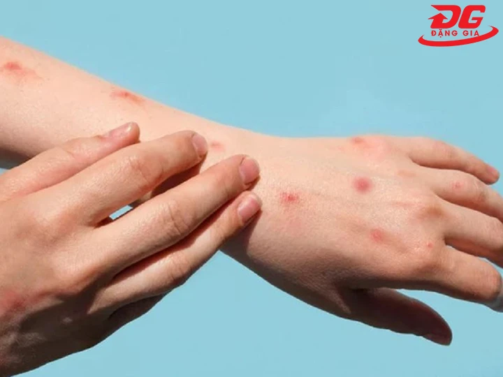 dễ mắc bệnh truyền nhiễm