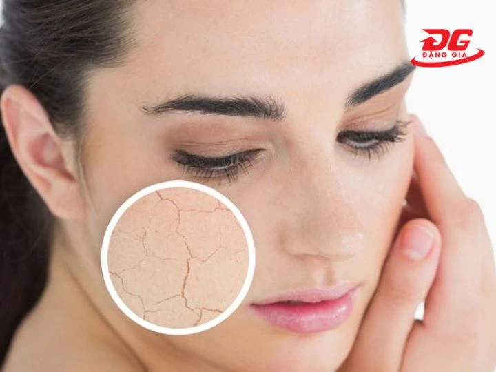 làm bề mặt da nứt nẻ và dạn nứt
