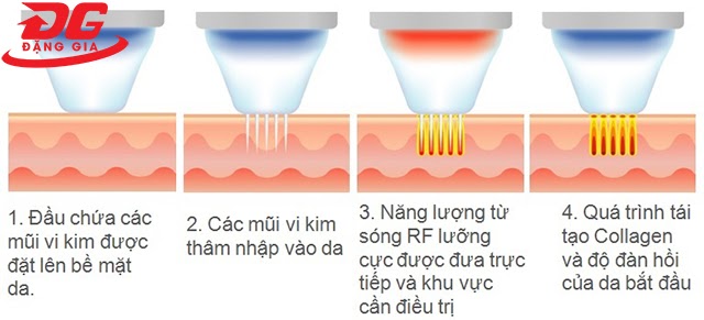 Ứng dụng của sóng RF trong làm đẹp